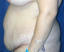Obesity increase surgical risk