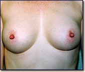 breast-post1
