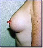 breast-post2
