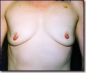 breast-pre1