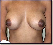breast08-post1