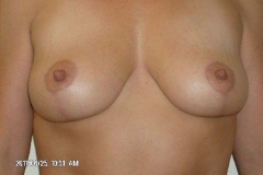 breast14-after03