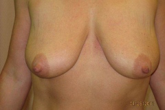 Breast ptosis or sagging